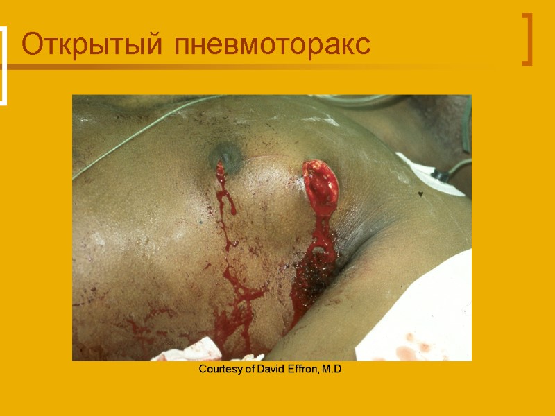 Открытый пневмоторакс Courtesy of David Effron, M.D.